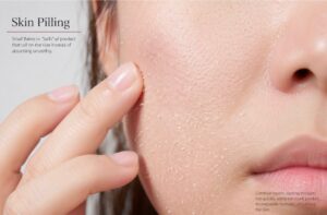 Skin Pilling